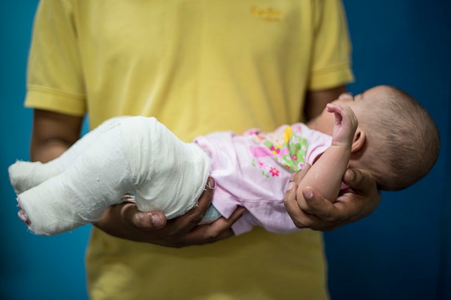A newborn, with his first cast, begins his 4 year program. Him and other children, born with clubfoot, now have a chance for a better future free from disabilities. 